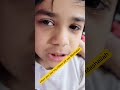 I got injured pray for me #viralreels #ytshorts #cute #foryou #foryoupage #india #pakistan #world