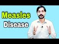 Measles Disease | Measles Virus | Causes | Symptoms | Treatment and Transmission