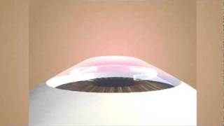 Intrastromal Corneal Ring Segments Intacs