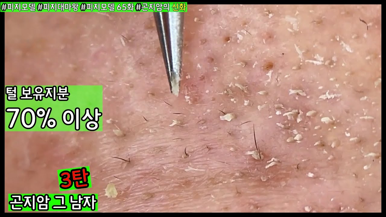 피지 직접 뽑아드렸습니다 _ 피지제거 블랙헤드제거 피지뽑기 _ 곤지암역 피지모델 남성분 털 보유지분 70% 이상입니다 3탄 ...