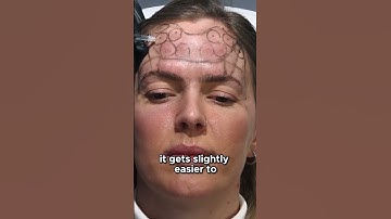 Avoiding Bruises in Botox Injections!