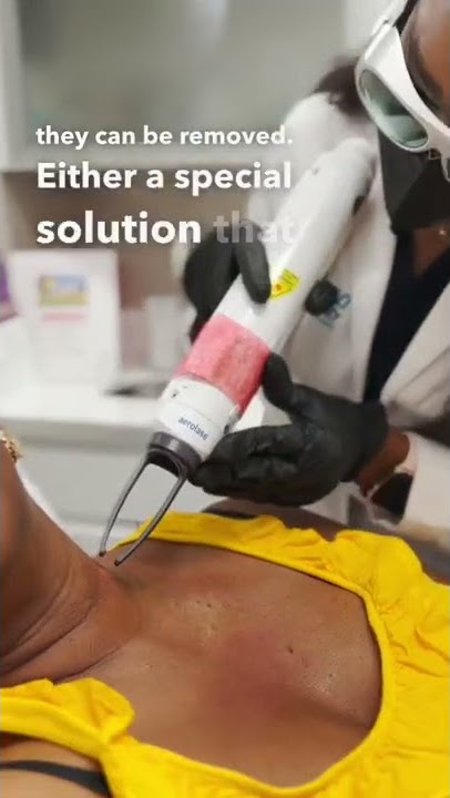 DPN removal