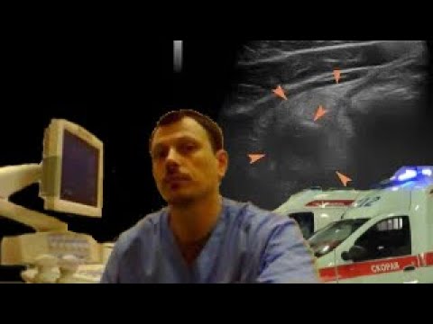 Детское УЗИ брюшной полости - Классический аппендикулярный инфильтрат у подростка