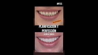 Carillas Dentales y Diseño Digital en Viña del Mar: Caso Clínico Real ✨