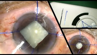 How to use the IRIS HOOKS - The proper technique of inserting and removing in a case of small pupil