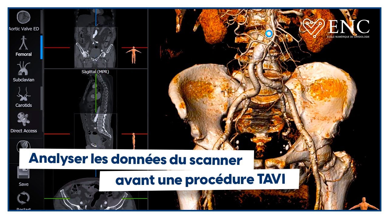Comment analyser un scanner avant TAVI ?