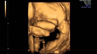 Baby Girl 4D Ultrasound Scan At 22 Weeks