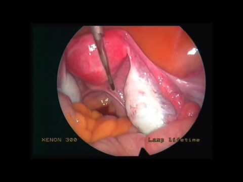 5.14 Laparoscopy: normal pelvic organs (no audio)