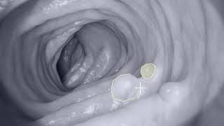 Med AI  Endoscopy Annotation