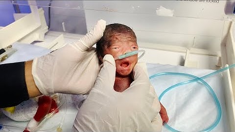 Extremely Low Birth Weight Baby Resuscitation in NICU | Life-Saving Care Moments😯💖
