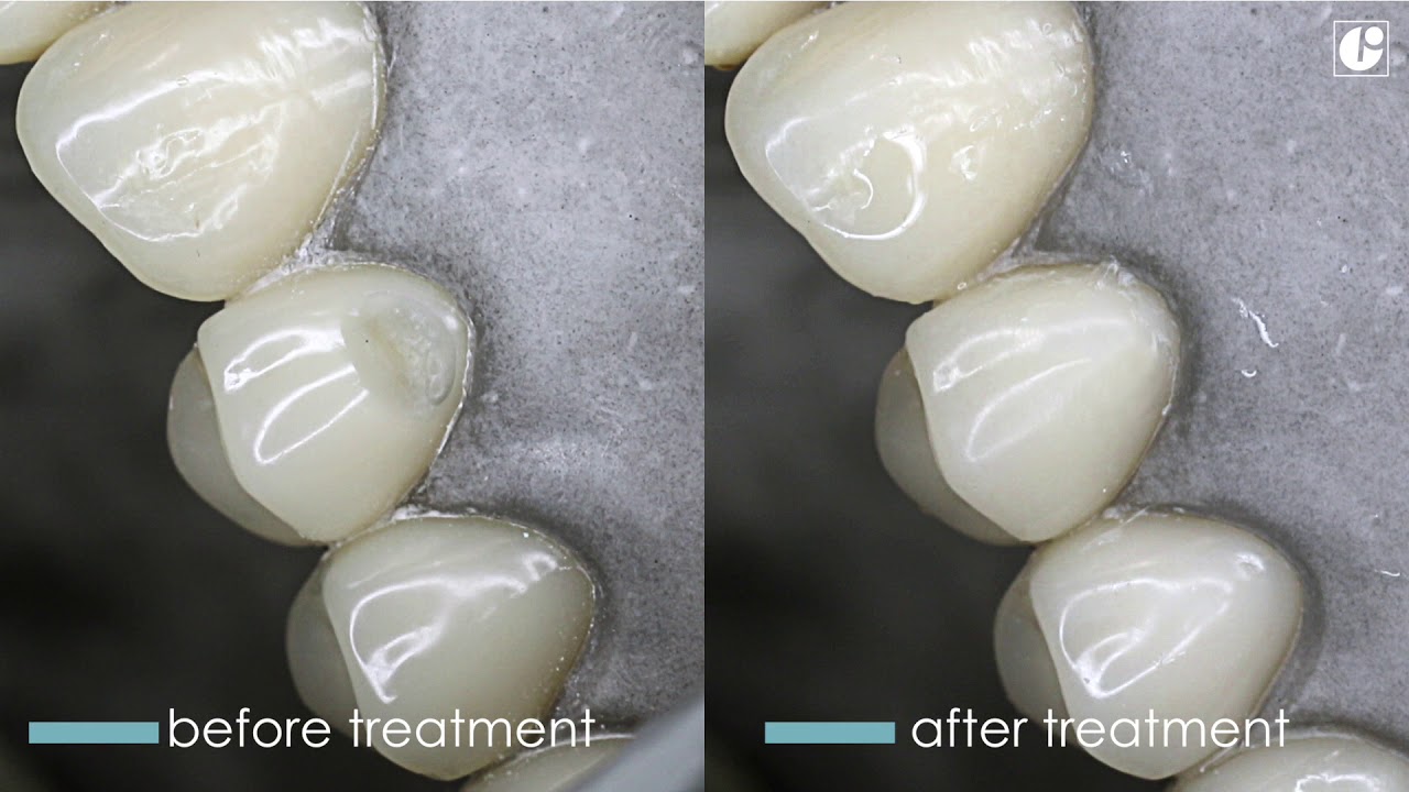 OliFlow SE & OliFlow - OLIDENT [EN]