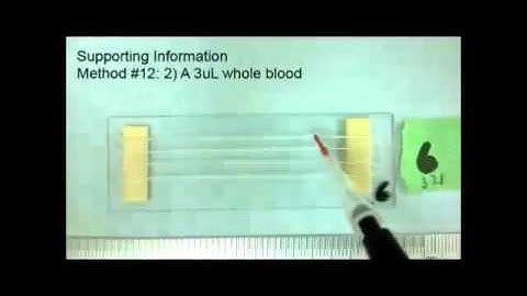 EDTA-treated cotton-thread microfluidic device for one-step whole blood plasma separation and assay
