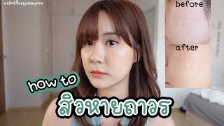 วิธีจบทุกสิวซ้ำซาก สิวหายถาวร + รีวิว Eucerin SOS Serum&Gel to Foam ตัวใหม่ | This is Pear