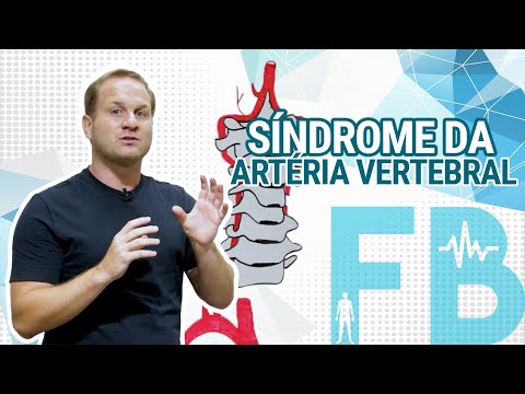 Vídeo: Síndrome Da Artéria Vertebral Na Osteocondrose Cervical: Sintomas E Tratamento