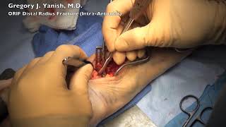 Distal Radius Fracture ORIF Distal Radius Fracture ORIF