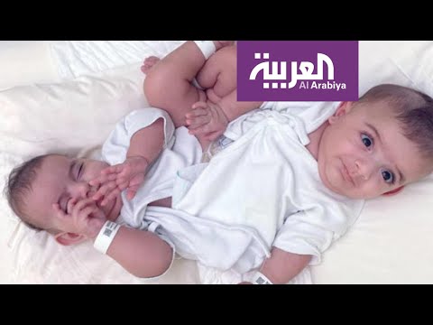 فيديو: من هما التوائم السيامية