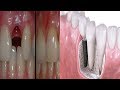 Amazing Discovery Goodbye Dental Implants Here&#39;s How to Grow Your Own Teeth in Just 9 Weeks!