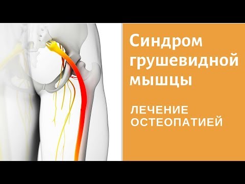 Что такое синдром грушевидной мышцы? Причины возникновения синдрома грушевидной мышцы. Лечение