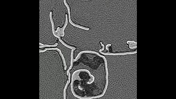 Three crystal-states imitate Belousov Zhabotinsky reaction in large totalistic cellular automata