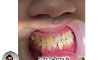 khớp cắn ngược và lệch mặt thật giả