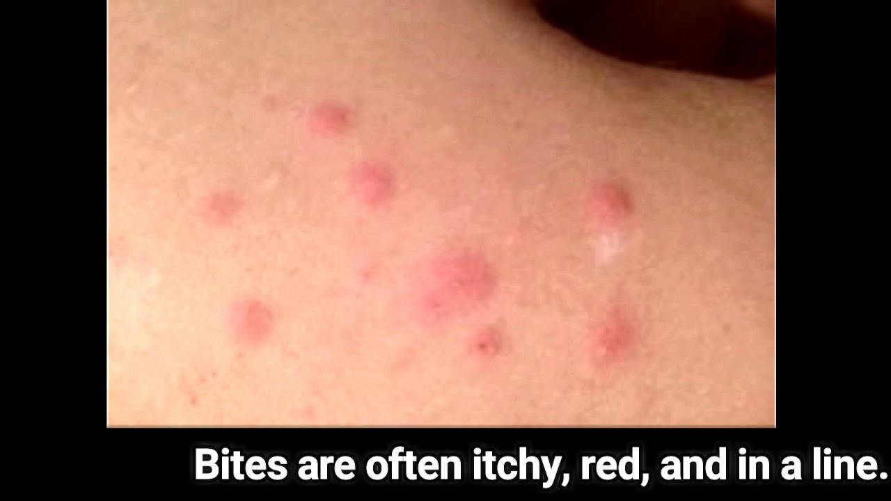 Bed Bug Bites Images Youtube