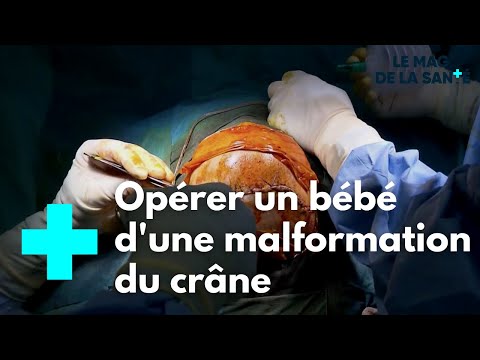 Vidéo: Craniosténose - Traitement, Craniosténose Chez Les Nouveau-nés