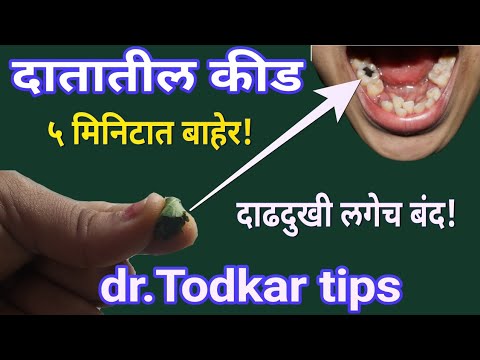 दातातील कीड 5 मिनिटात बाहेर।दाढ दुखीसाठी घरगुती उपाय।dental caries home remedy.डॉ तोडकर उपाय दातकिड