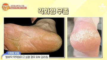 ☆유형별☆ 올바른 무좀 치료 방법! | 행복한 아침 387 회