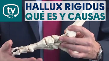 ¿Qué ocurre si no se trata el hallux rigidus?