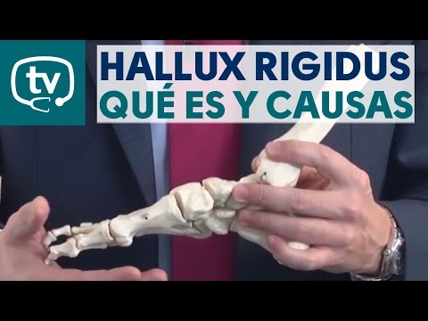 Video: ¿Puede el hallux rigidus causar dolor de cadera?