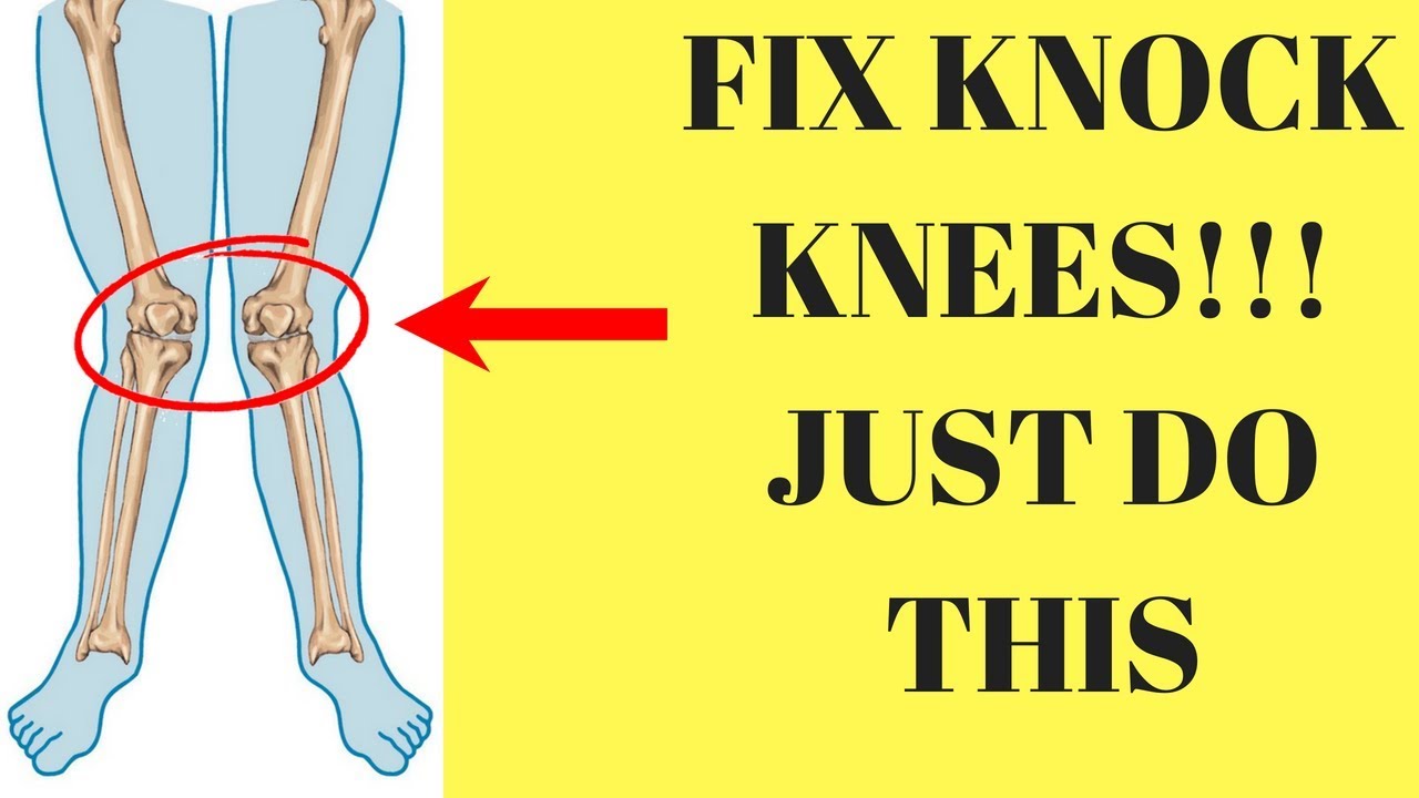 best exercises to correct knock knees - YouTube