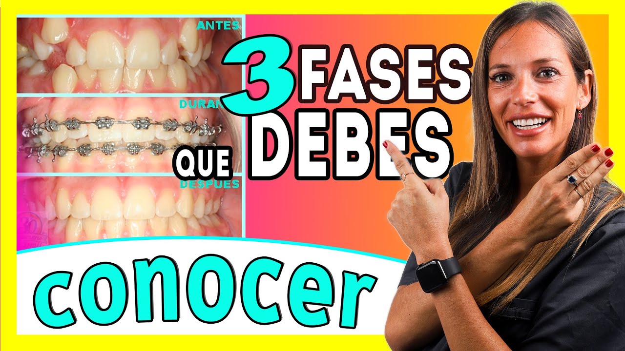 (Brackets proceso 𝗠𝗘𝗦 𝗮 𝗠𝗘𝗦 📆) Las ③ 𝐄𝐓𝐀𝐏𝐀𝐒 del TRATAMIENTO de Ortodoncia Te lo explico FÁCIL (Brackets proceso 𝗠𝗘𝗦 𝗮 𝗠𝗘𝗦 📆) Las ③ 𝐄𝐓𝐀𝐏𝐀𝐒 del TRATAMIENTO de Ortodoncia Te lo explico FÁCIL
