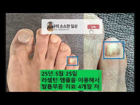 8개월 써본 라셀턴 앰플 후기, '돈 버렸나?' 솔직 리뷰 (ft. 전후 사진) #규의소소한일상 #라셀턴앰플 #발톱무좀치료
