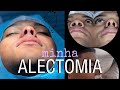 MINHA ALECTOMIA + Pós operatório