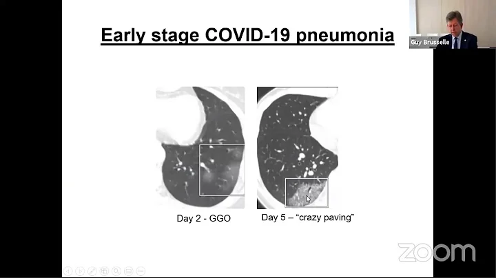 COVID-19: Potential impact on asthma patients