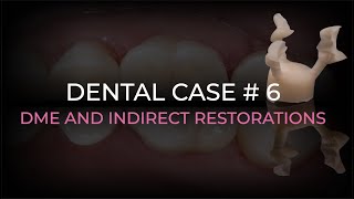 DENTAL CASE 6    |   DME AND INDIRECT RESTORATIONS