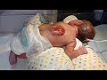 Gentle First Dressing of MMC Newborn After Cesarean Delivery | Critical Neonatal Care