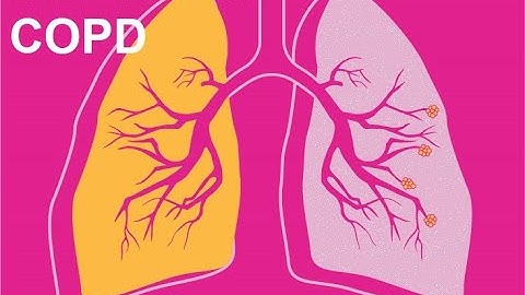 ICD-10-CM - COPD