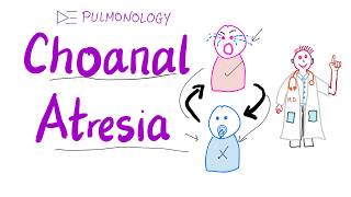 Choanal Atresia - Pink on crying, blue on breastfeeding 🤱- ENT & Pulmonology screenshot 4