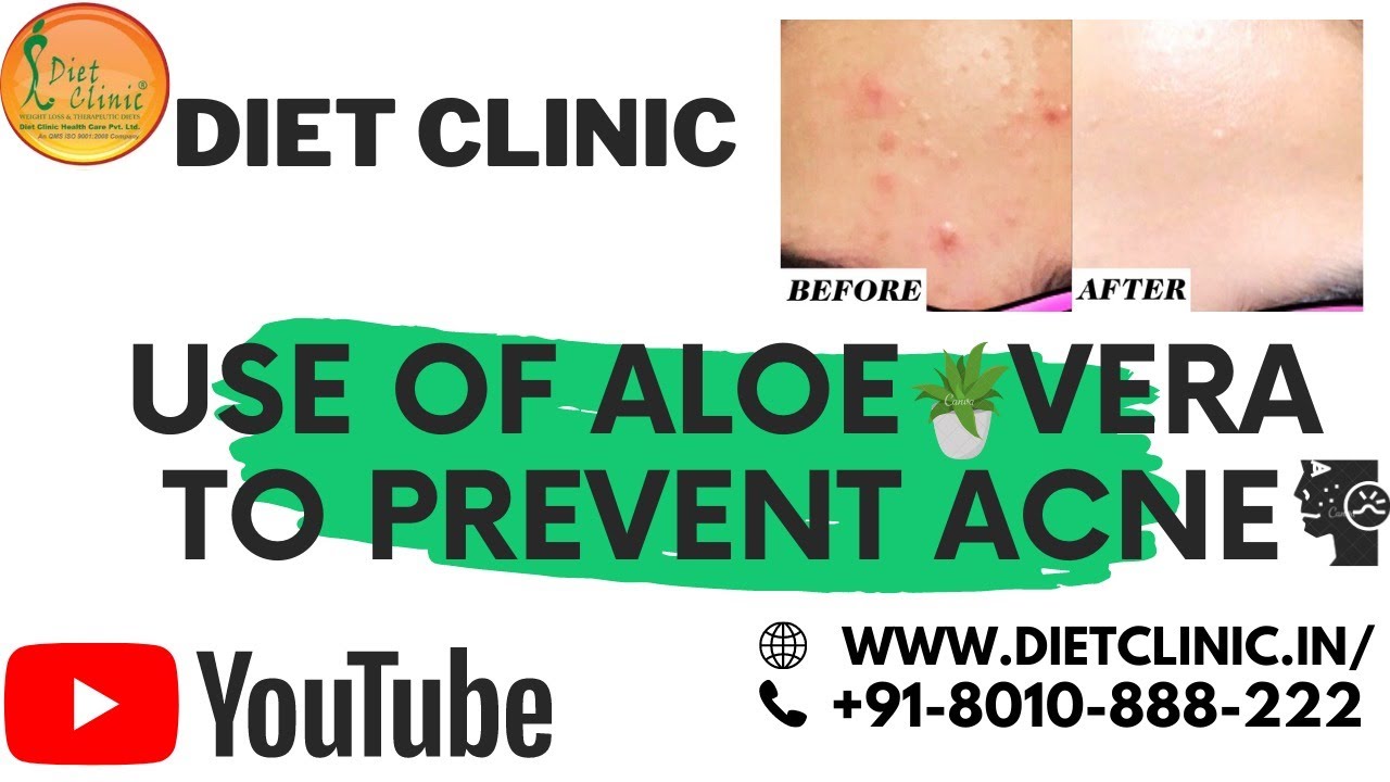 Using Aloe Vera to Prevent Acne 