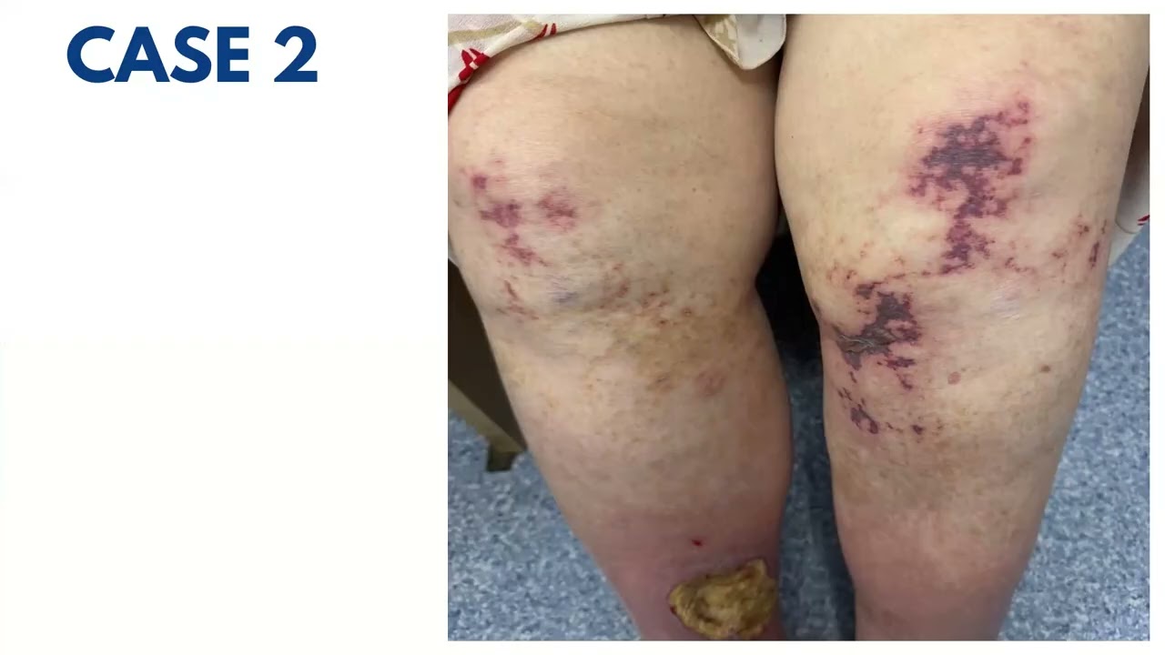 The Cutaneous Approach to Vasculitis