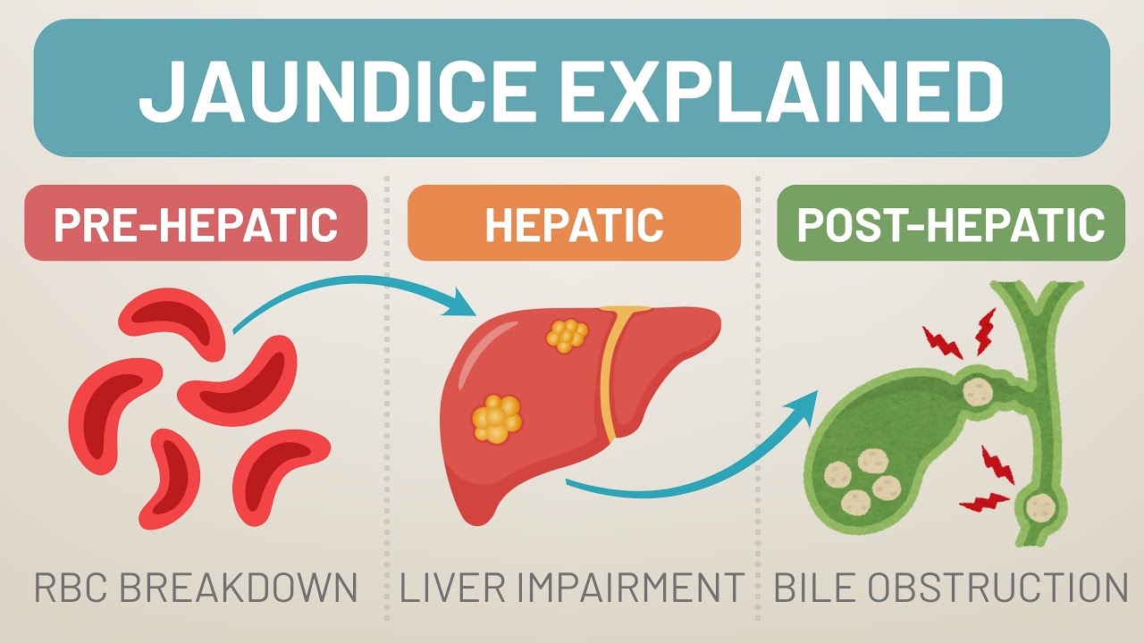 Jaundice Explained | Pre-hepatic, Hepatic & Post-hepatic Causes