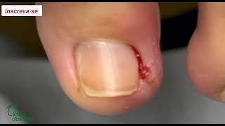 Unhas encravadas 2023/02 #nails #ingrowntoenail #infectednail  @podologoleonardovieira