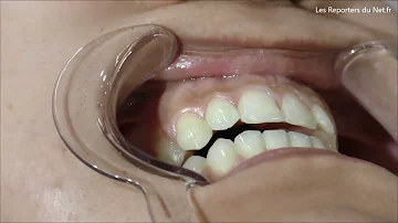 Comment faire une pose de strass dentaire