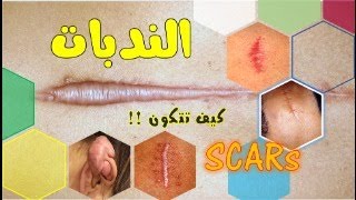 الندبات .. كيف تتكون أنواعها وأشكالها|| كيف تلتئم الجروح.. || Scars, types and shapes