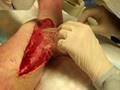 Part 1 - Brad's Surgery - Exploding Leg Bandage Removal