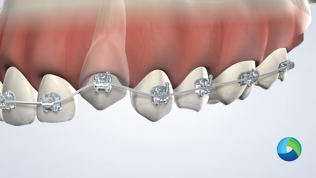 Expose and Bond in New Brunswick, NJ at Oral Surgery Group YouTube