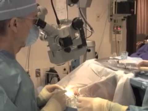 Gimbel eye surgery cost