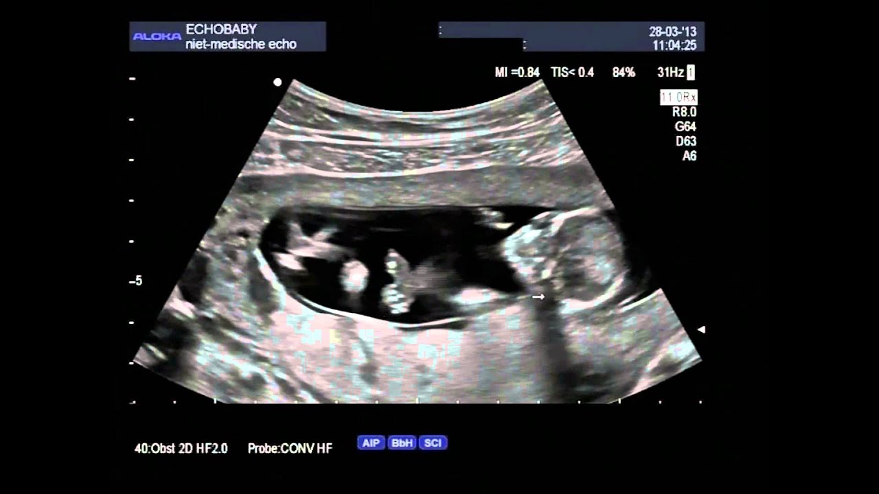 Pretecho geslachtsbepaling 13 weken meisje met gesproken uitleg