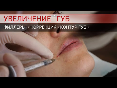 Коррекция губ. Коррекция контура губ и поднятие уголков губ.